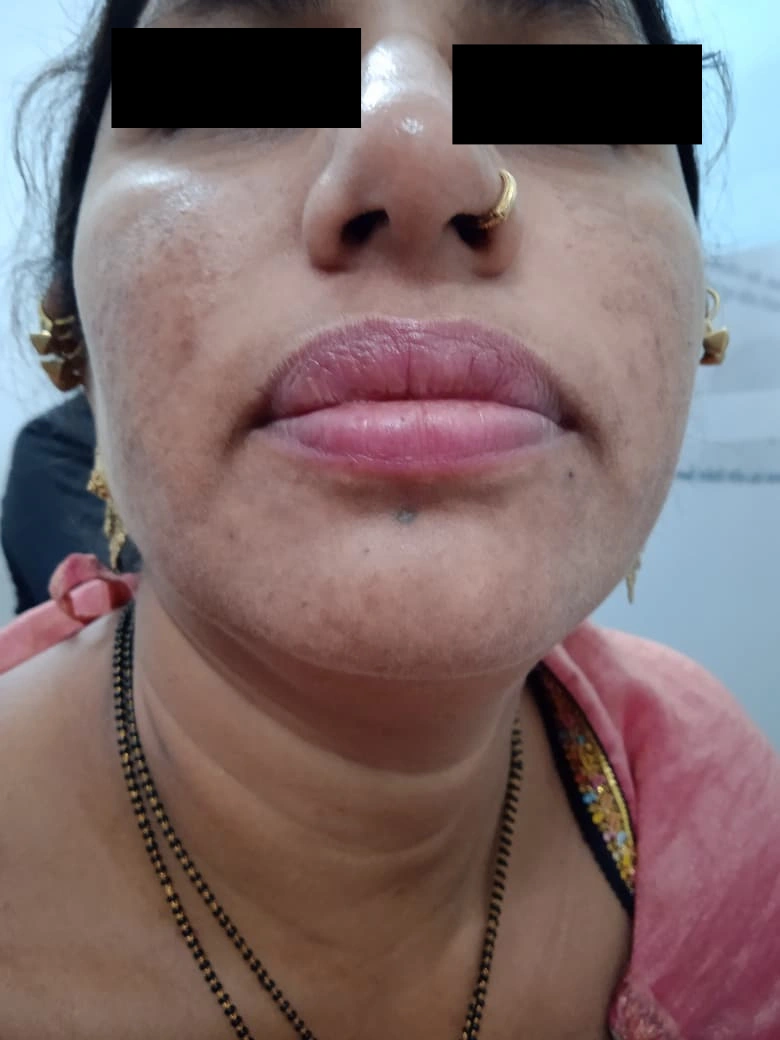 Acne Marks Treatment treatment result - after