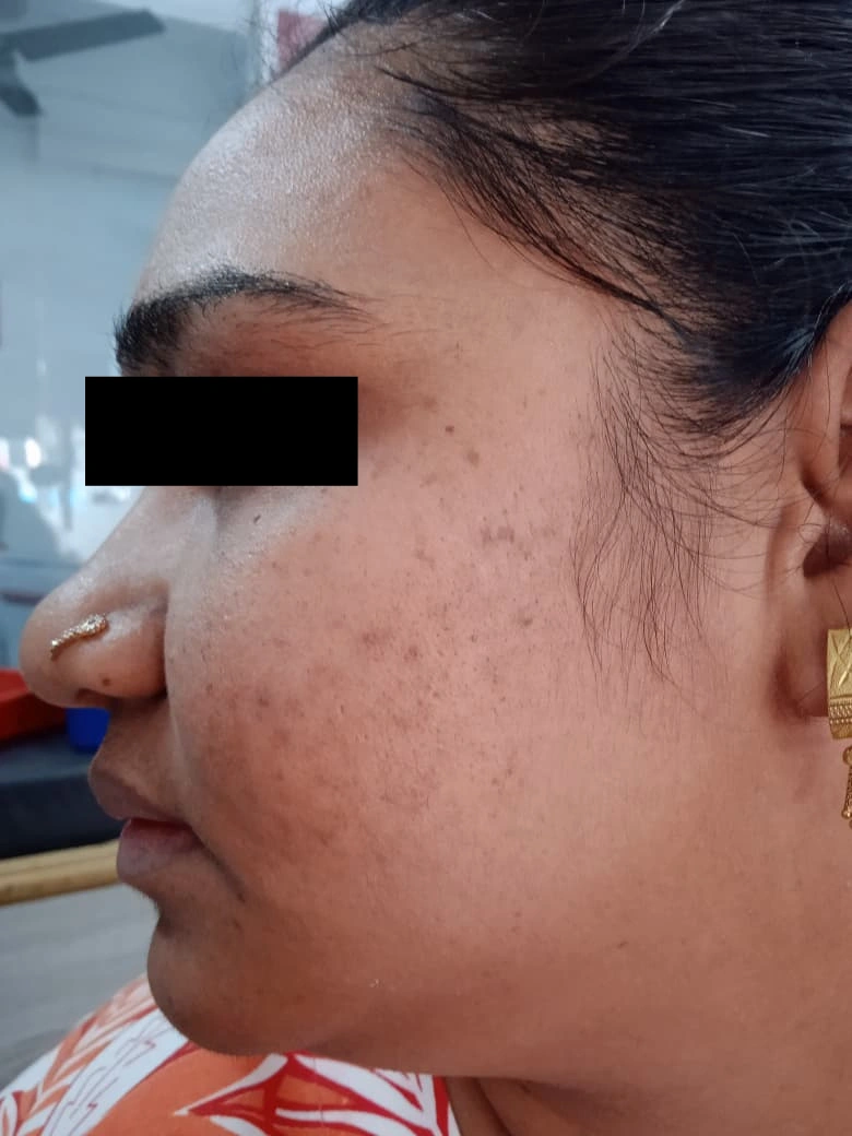 Acne Treatment treatment result - after