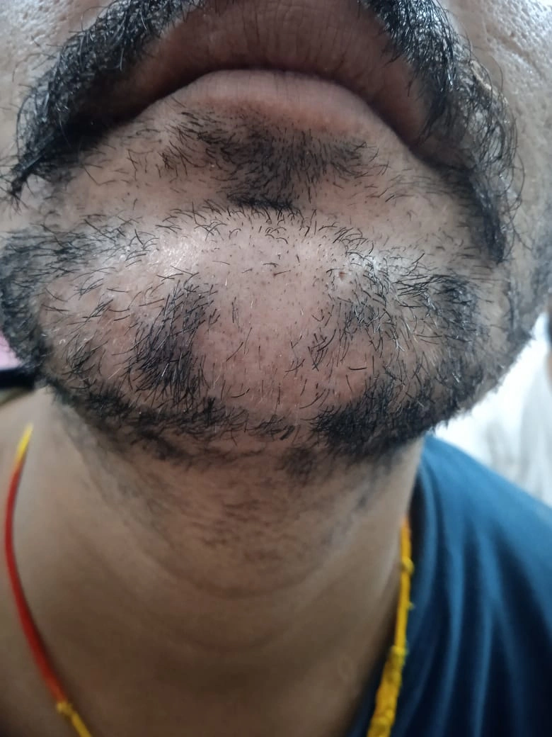 Alopecia Areata treatment result - before