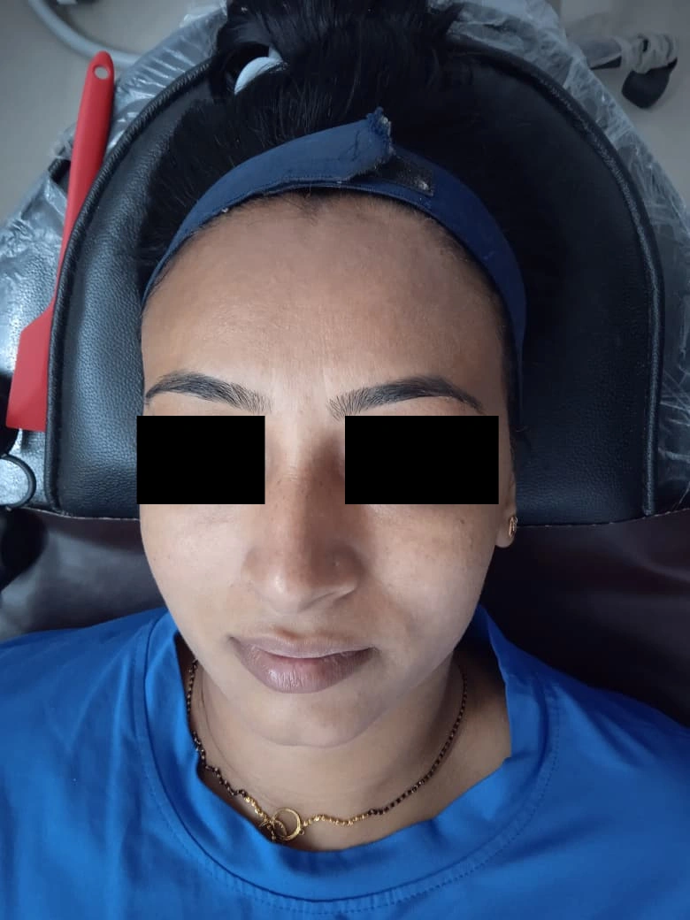 Carbon Facial treatment result - after