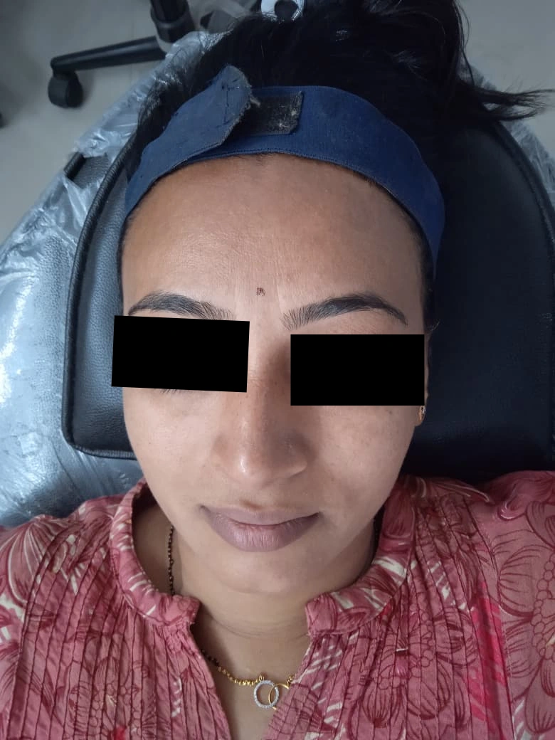 Carbon Facial treatment result - before