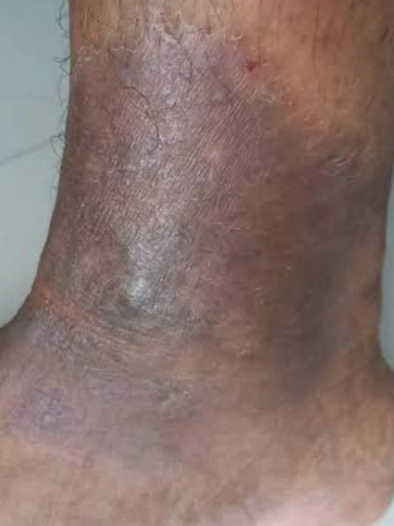 Eczema treatment result - after