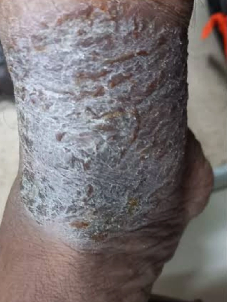Eczema treatment result - before