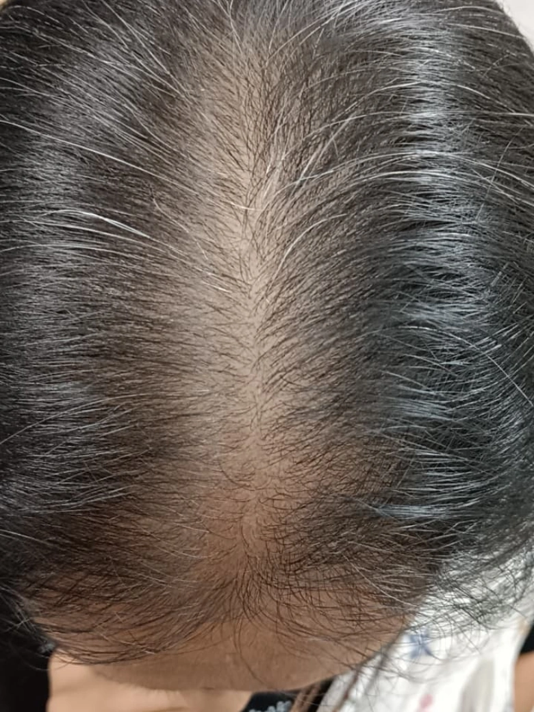 Hair Regrowth Treatment PRP treatment result - after