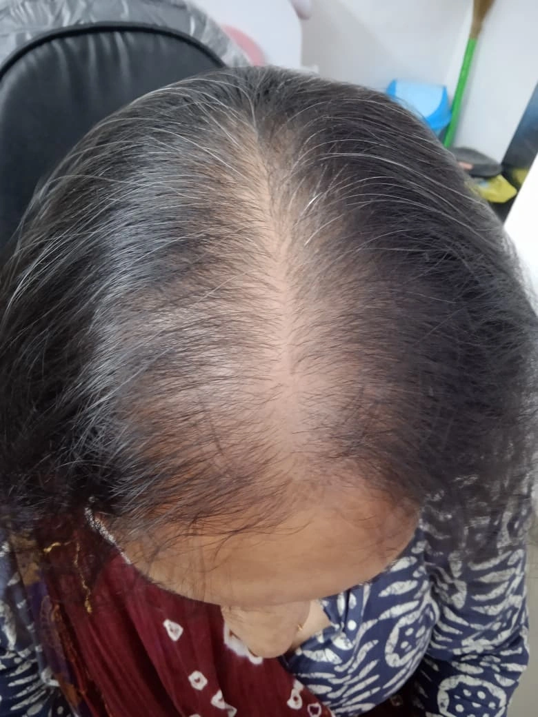 Hair Regrowth Treatment PRP treatment result - before