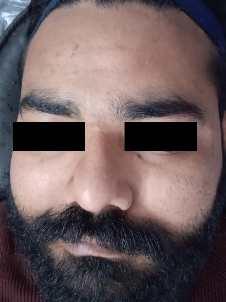 Photofacial treatment result - after