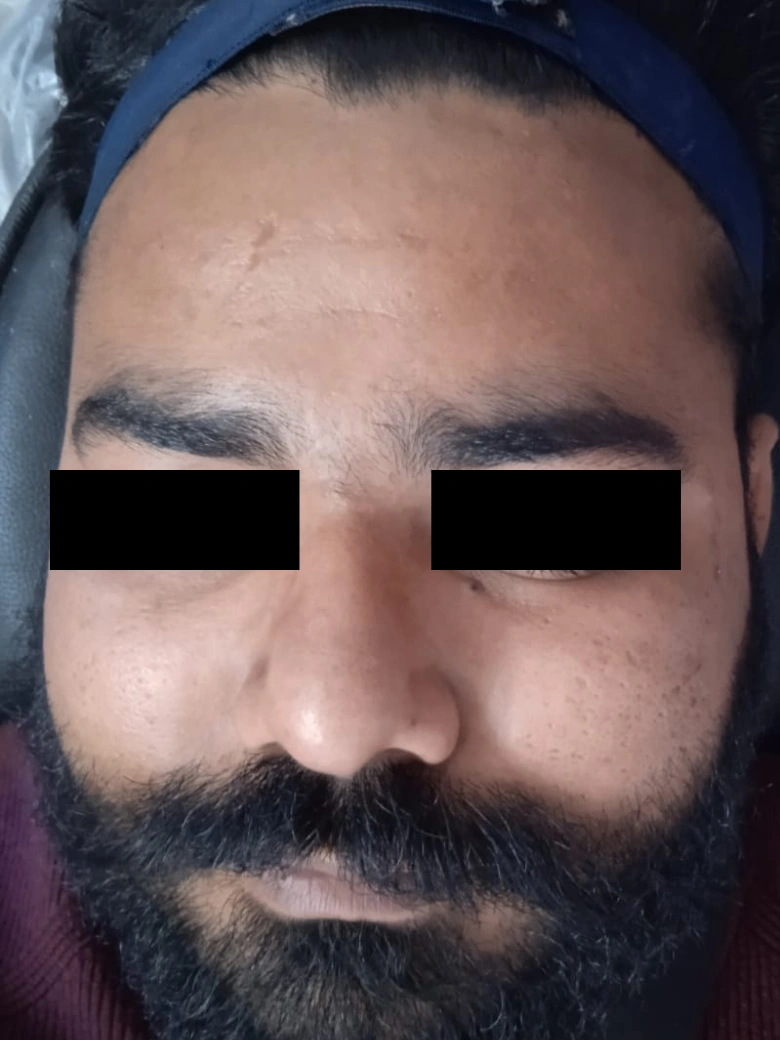 Photofacial treatment result - before