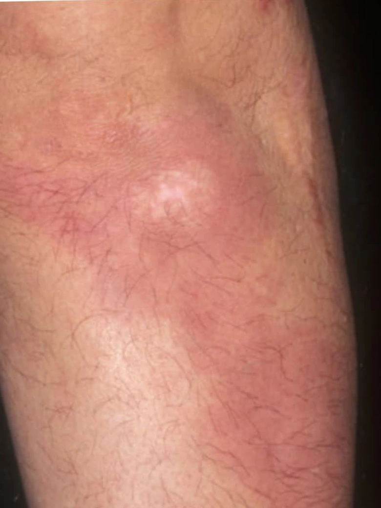 Psoriasis treatment result - after