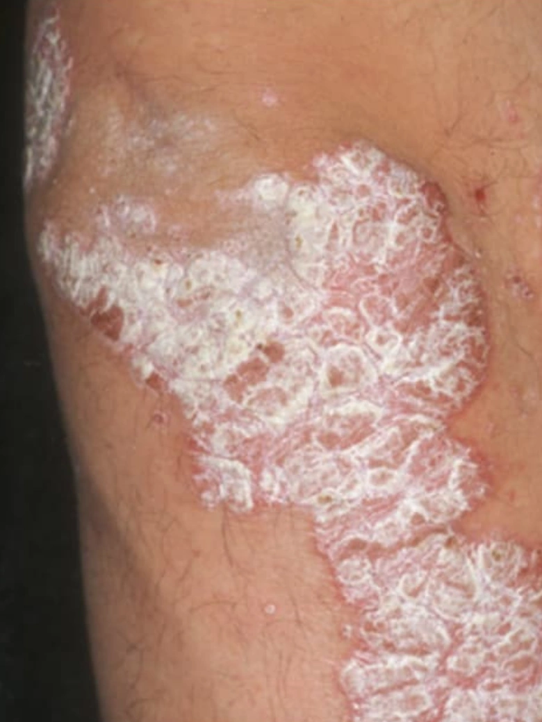 Psoriasis treatment result - before