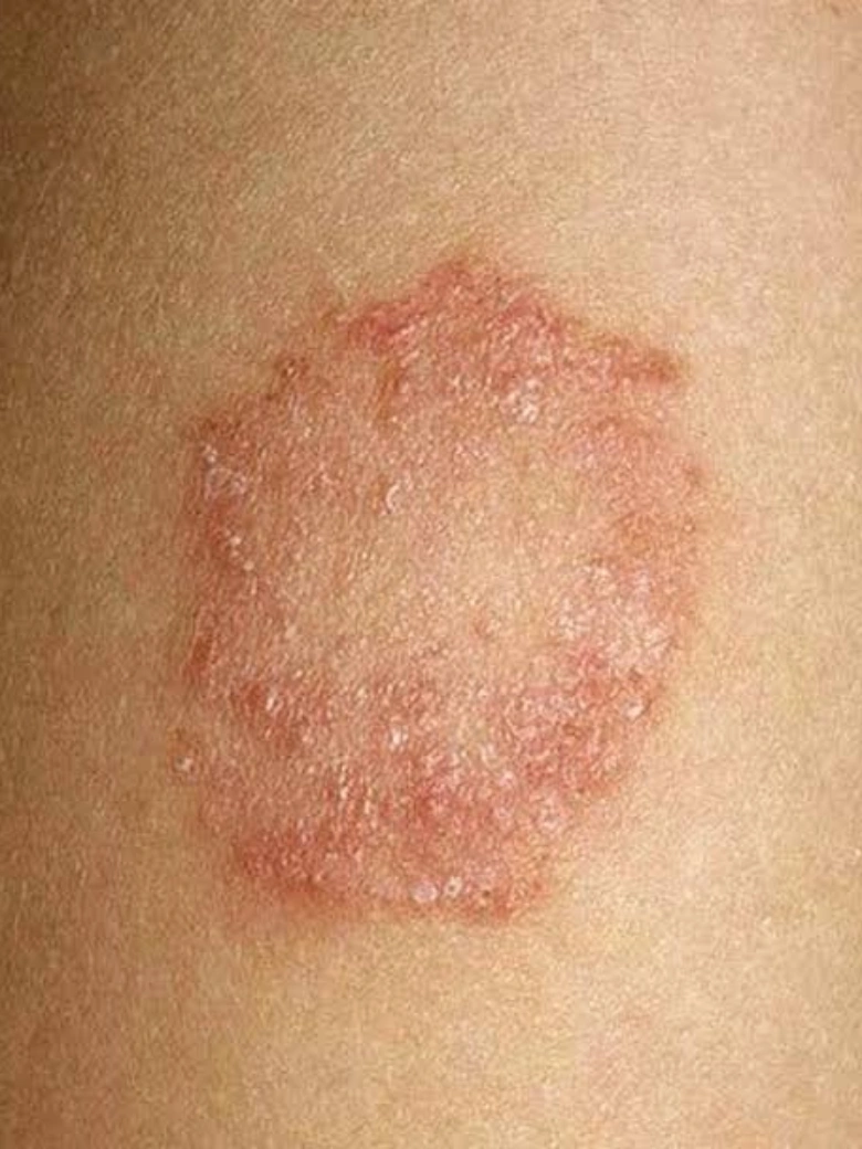 Skin Fungal Infection treatment result