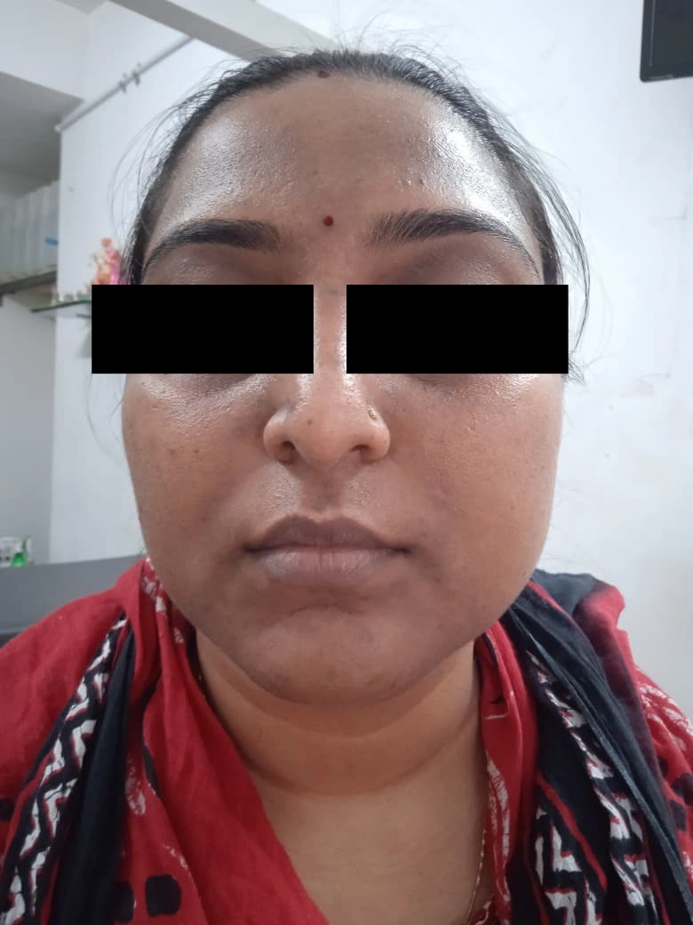 Skin Hyperpigmentation Treatment treatment result - after