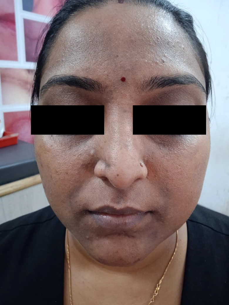 Skin Hyperpigmentation Treatment treatment result - before