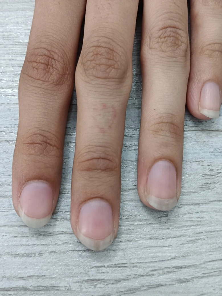 Tattoo Removal treatment result - after